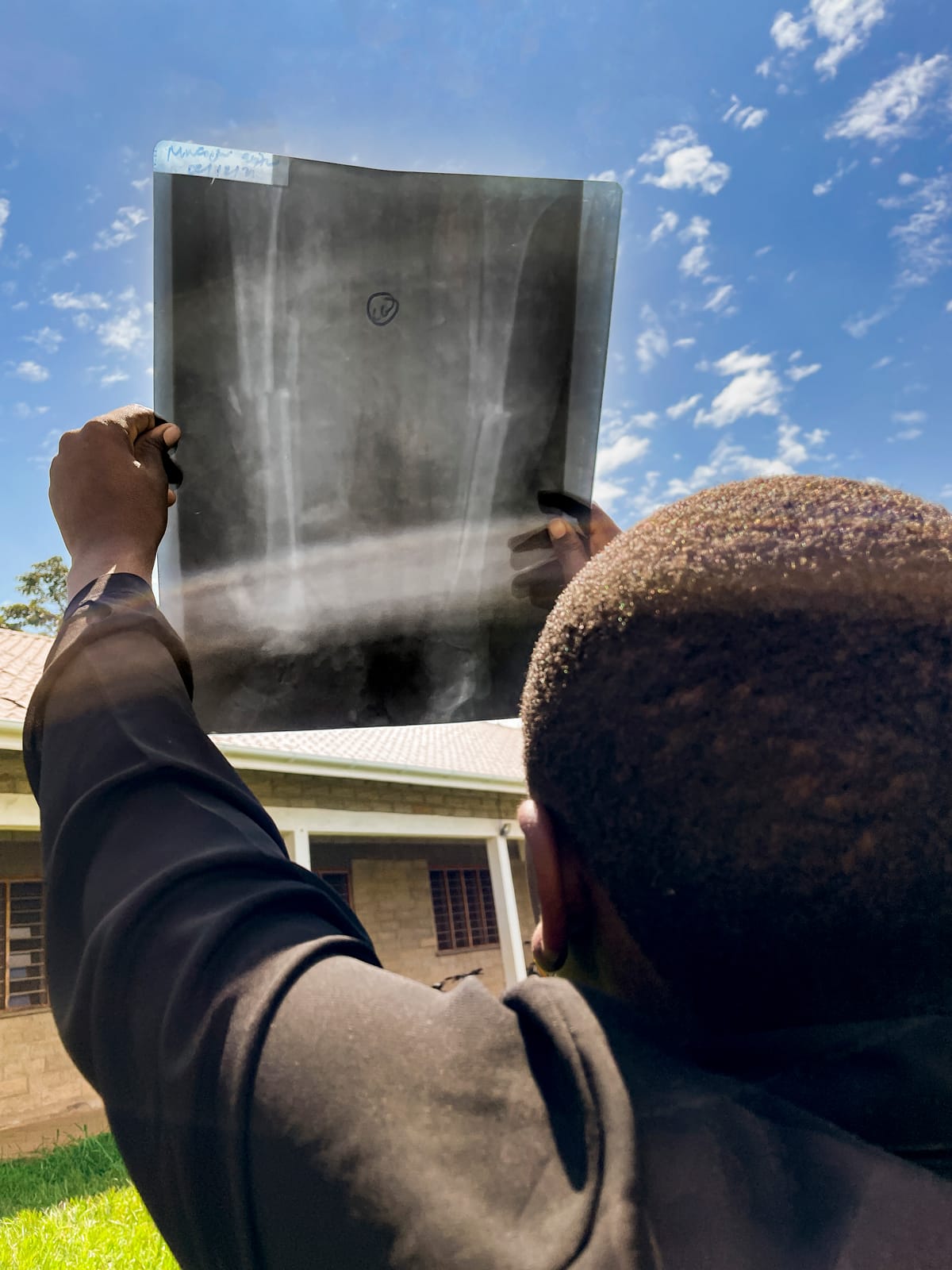 Esther looking up at an X-Ray of her leg with the bright blue sky above.